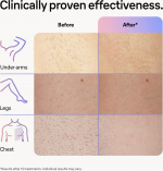 Braun Smart IPL Skin iexpert PL7253 IPL-laite Braun Smart IPL Skin iexpert PL7253 IPL-laite