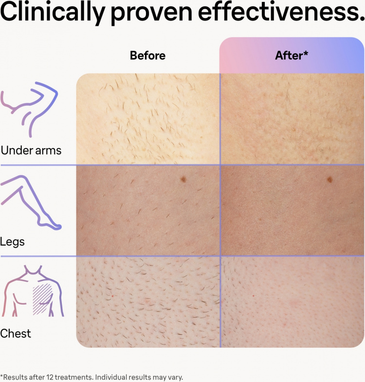 Braun Smart IPL Skin iexpert PL7253 IPL-laite Braun Smart IPL Skin iexpert PL7253 IPL-laite